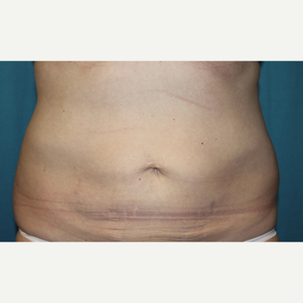 45-54 year old woman treated with CoolSculpting after 3027679