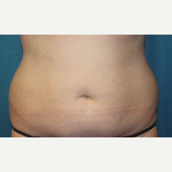 45-54 year old woman treated with CoolSculpting before 3027679