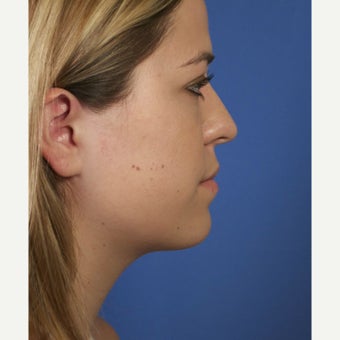 Neck Lipocontouring to Create a More Defined Jawline after 1544053