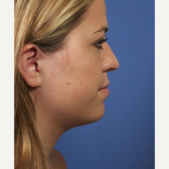 Neck Lipocontouring to Create a More Defined Jawline before 1544053