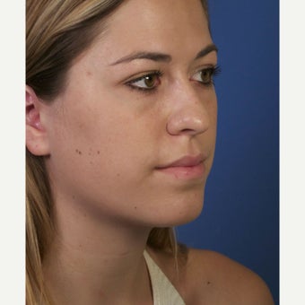Neck Lipocontouring to Create a More Defined Jawline 1544053