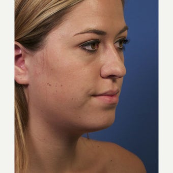 Neck Lipocontouring to Create a More Defined Jawline 1544053