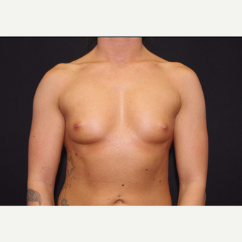 25-34 year old woman treated with Breast Implants before 3440968