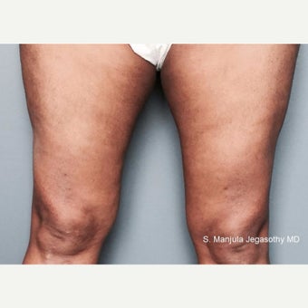 Tighten Thighs with Viora® Radiofrequency Laser after 1942308