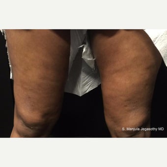 Tighten Thighs with Viora® Radiofrequency Laser before 1942308