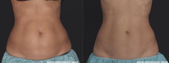 CoolSculpting helps to define and smoothen the abdomen. before 1482575