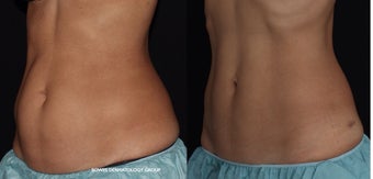 CoolSculpting helps to define and smoothen the abdomen. 1482575