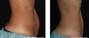 CoolSculpting helps to define and smoothen the abdomen. after 1482575