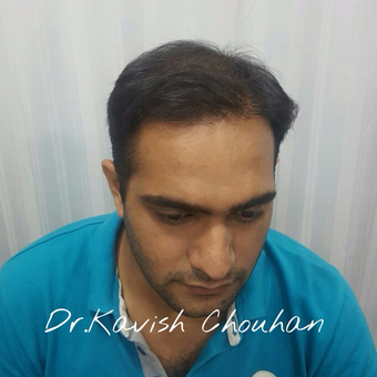 25-34 year old man treated with Hair Transplant after 2836771
