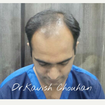 25-34 year old man treated with Hair Transplant before 2836771