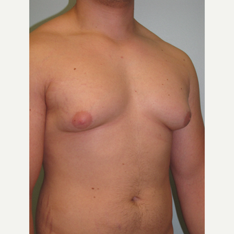 18-24 year old man treated with Male Breast Reduction before 3644001