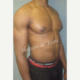 35-44 year old man treated with Male Breast Reduction after 3333028