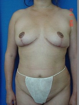 Mommy Makeover after 2 pregnancies after 1368597