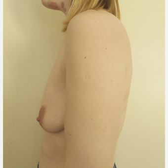 35-44 year old woman treated with Breast Lift before 3428164