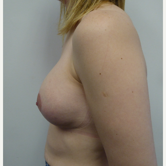 35-44 year old woman treated with Breast Lift after 3428164