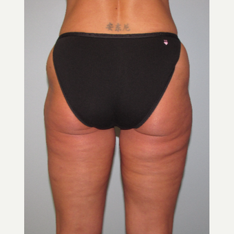 45-54 year old woman treated with Liposuction Revision before 3644253