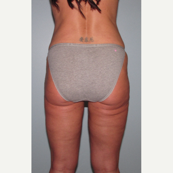 45-54 year old woman treated with Liposuction Revision after 3644253