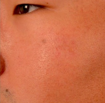 25-34 year old man treated with Microneedling after 2048126