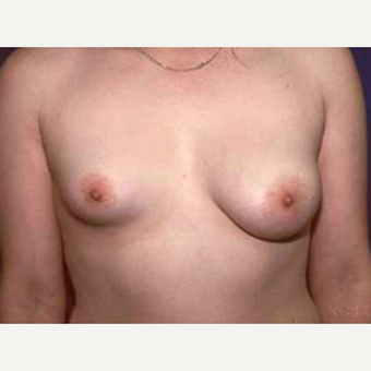 18-24 year old female treated with Breast Augmentation for Breast Asymmetry before 3815549