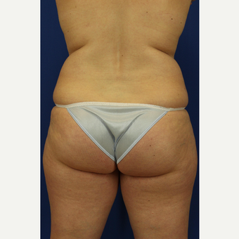 35-44 year old woman treated with Liposuction before 3748190