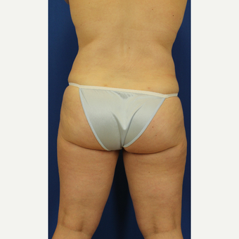 35-44 year old woman treated with Liposuction after 3748190