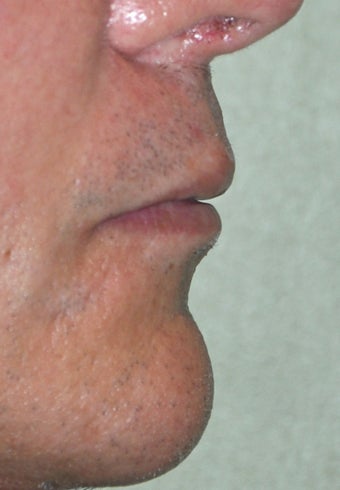 35 Year Old Male Who Desired Larger Lips 739013