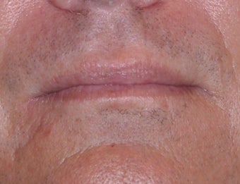 35 Year Old Male Who Desired Larger Lips before 739013