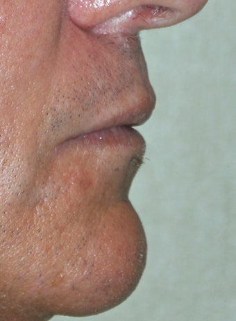 35 Year Old Male Who Desired Larger Lips 739013