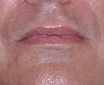 35 Year Old Male Who Desired Larger Lips after 739013