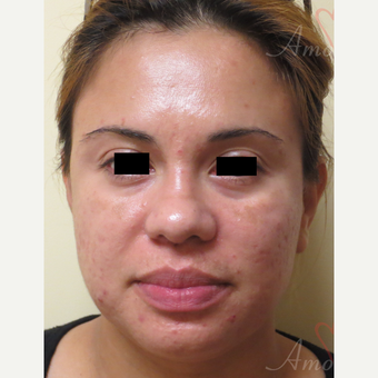 25-34 year old woman treated with Fractional CO2 Laser before 3375113