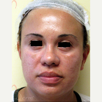 25-34 year old woman treated with Fractional CO2 Laser after 3375113