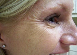 Botox to the Crow's Foot Area before 85858