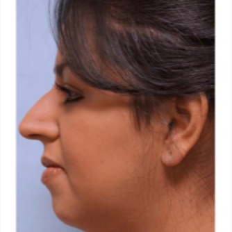 25-34 year old woman treated with Rhinoplasty before 3691912