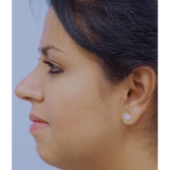25-34 year old woman treated with Rhinoplasty after 3691912