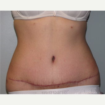 18-24 year old woman treated with Liposuction after 3140142