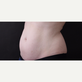 46 year old woman treated with CoolSculpting before 3168879