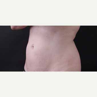 46 year old woman treated with CoolSculpting after 3168879