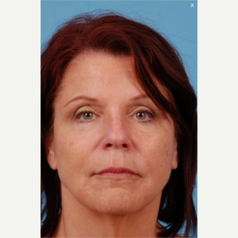 Liquid Facelift: 55-64 yr old female after 1606751