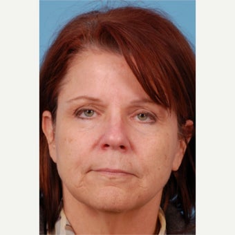 Liquid Facelift: 55-64 yr old female before 1606751