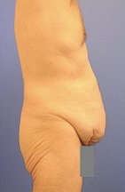 Body Lift before 296708