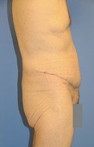 Body Lift after 296708