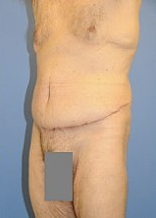 Body Lift 296708