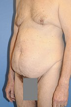 Body Lift 296708