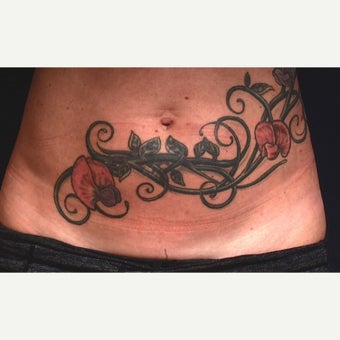 35-44 year old woman treated with CoolSculpting after 1640200