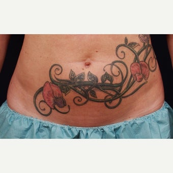 35-44 year old woman treated with CoolSculpting before 1640200