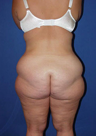 Body Lift before 1558012