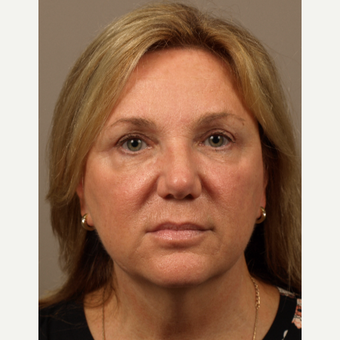 45-54 year old woman treated with Eyelid Surgery after 3252568