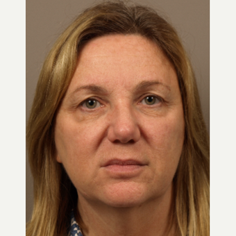 45-54 year old woman treated with Eyelid Surgery before 3252568
