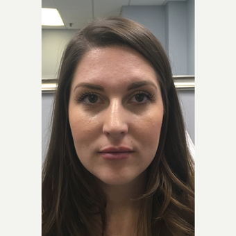25-34 year old woman treated with Botox after 3802225