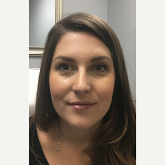 25-34 year old woman treated with Botox before 3802225